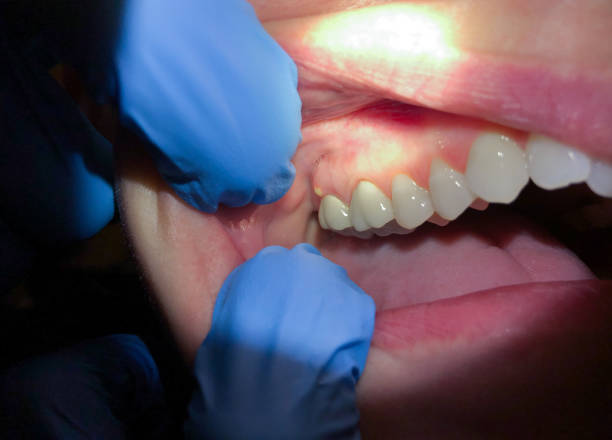Best Urgent Tooth Repair  in Lead, SD
