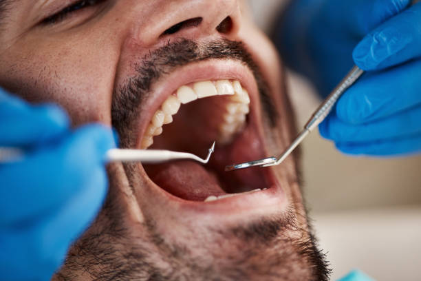 Tooth Infection Emergency Dentist in SD