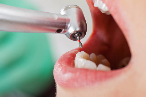 Best Root Canal Emergency Dentist  in Lead, SD